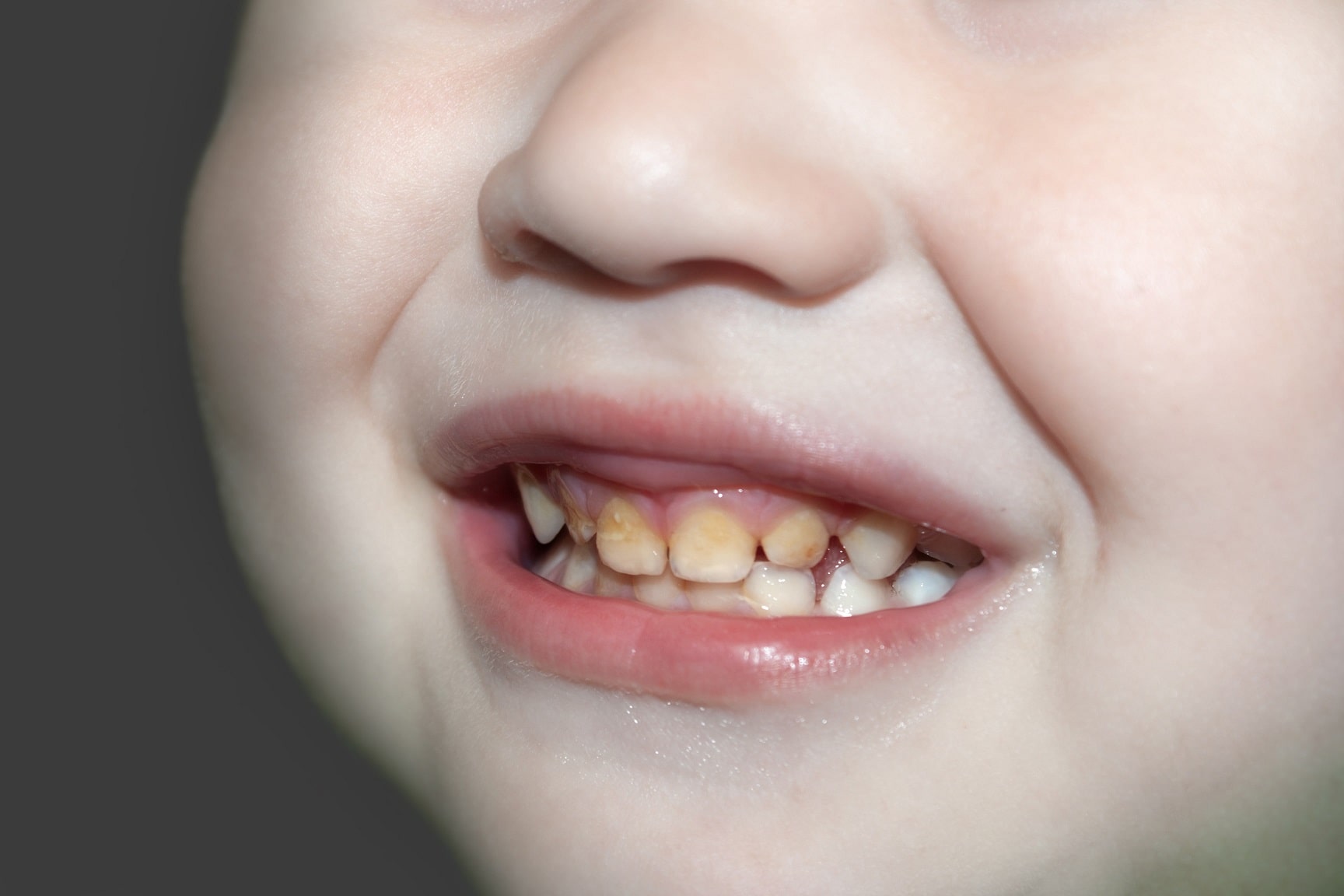 Tooth decay in children How to prevent, spot and treat it